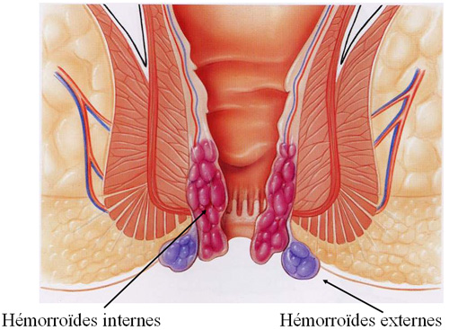 Hémorroïdes causes symptômes et complication