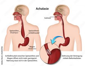 Achalasie cause symptôme et traitement.