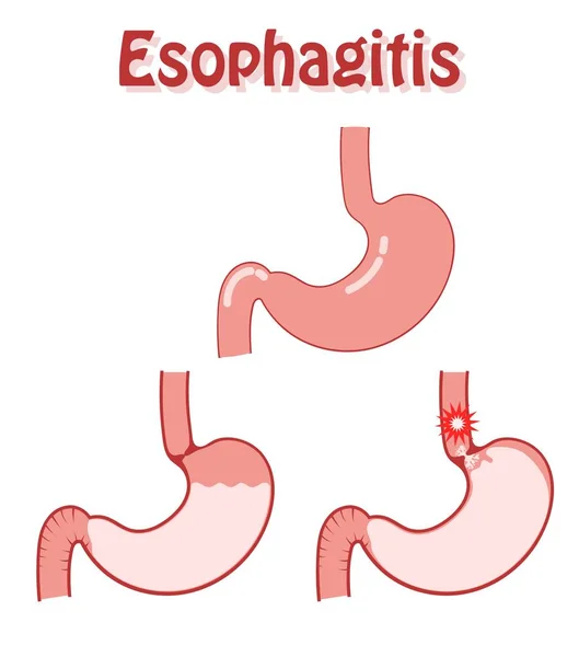 Œsophagite cause symptôme et traitement.