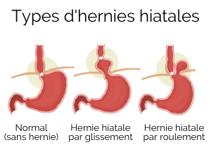 Hernie hiatale Cause Symptôme et traitement