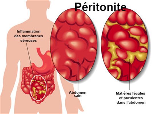 Péritonite cause symptôme et traitement.