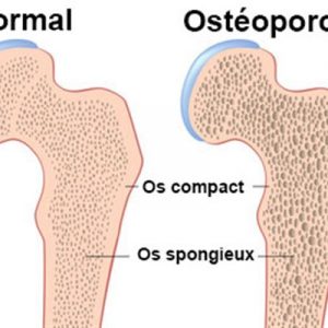 Ostéoporose traitement naturel