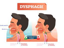 Dysphagie symptôme et traitement
