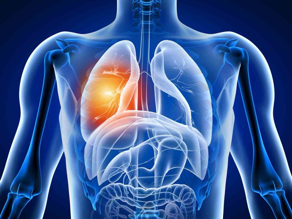 Bronchite cause symptôme et traitement