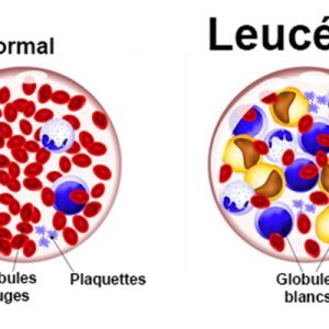Leucémie remède naturel