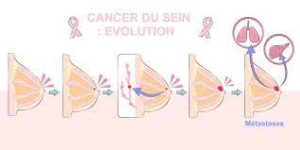 Traitement naturel contre cancer du sein