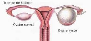 Kystes ovariens traitement naturel