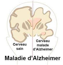 Signe et traitement la maladie d'Alzheimer
