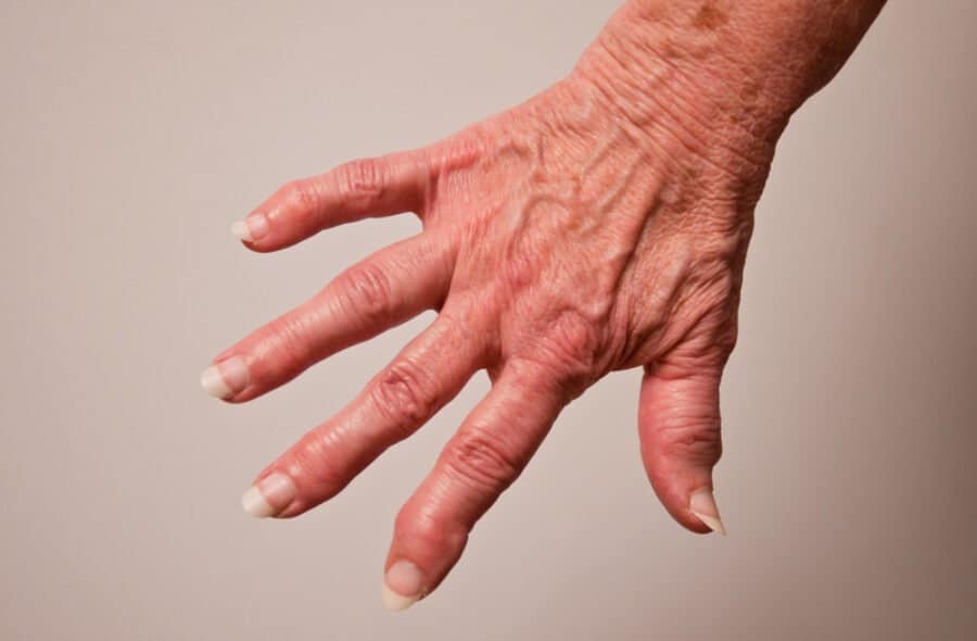 Arthrose causes symptômes et remède maison