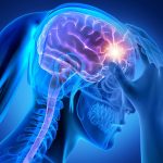 La migraine, quel remède naturel pour la guérir ?