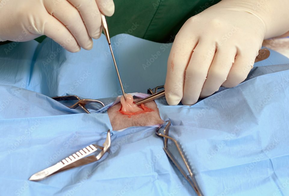 Ablation chirurgicale de l’utérus : Explications, Procédures et Conséquences